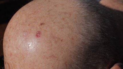 Vidac secures funding to advance skin cancer trials of novel ointment