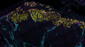 Breast cancer remodels lymphatic vessels to accelerate its spreading