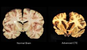 Chinese Neurosurgical Journal Study Urges Attention to Africa’s Chronic Traumatic Encephalopathy Research Deficit