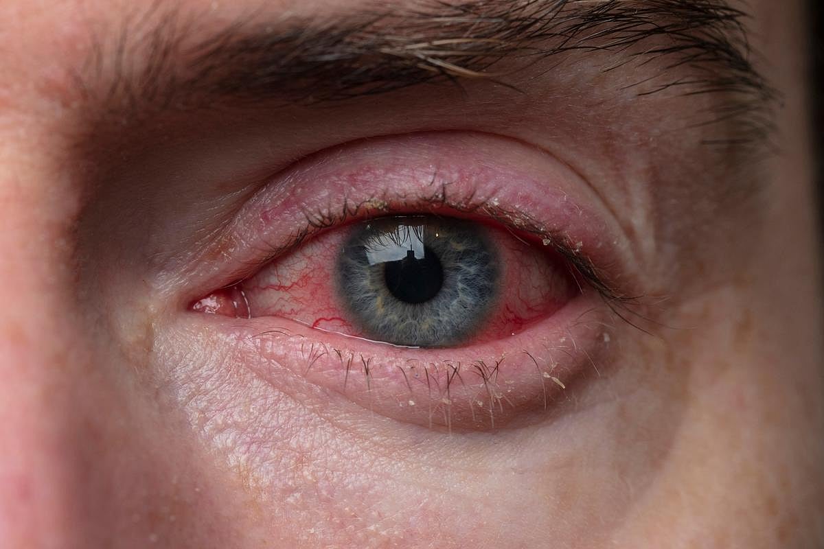 Allergic Conjunctivitis Linked to Increased Risk for Keratoconus