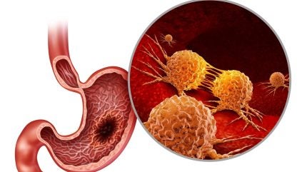 FDA approves Accord BioPharma’s HERCESSI for cancer treatment