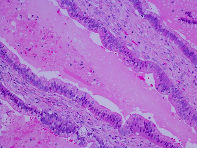 PCI and ChiRhoClin partner to prevent shortage of pancreatic diagnostic drug