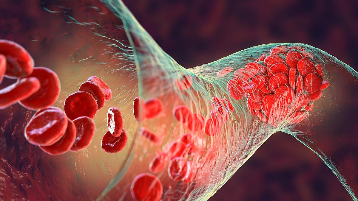 ACC: Catheter-Directed Fibrinolysis Added to Anticoagulation Improves Pulmonary Embolism Outcomes